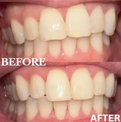 Dental bonding before and after