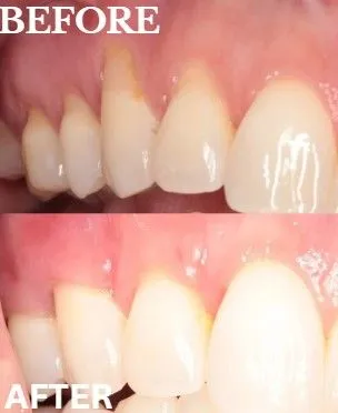Gum grafting before and after