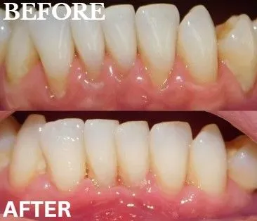 Gum grafting before and after
