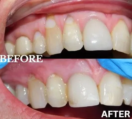 Gum grafting before and after