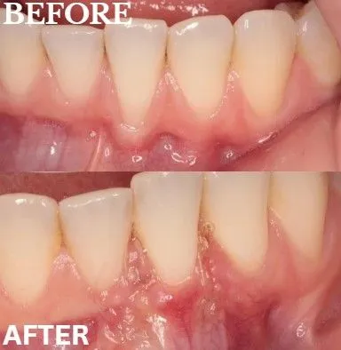 Gum grafting before and after
