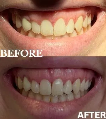 Gum contouring before and after