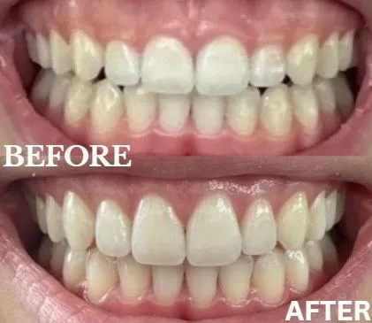 Gum contouring before and after