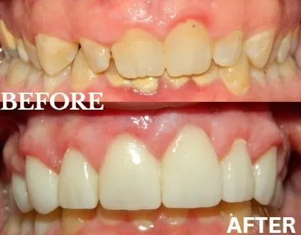 Gum contouring before and after