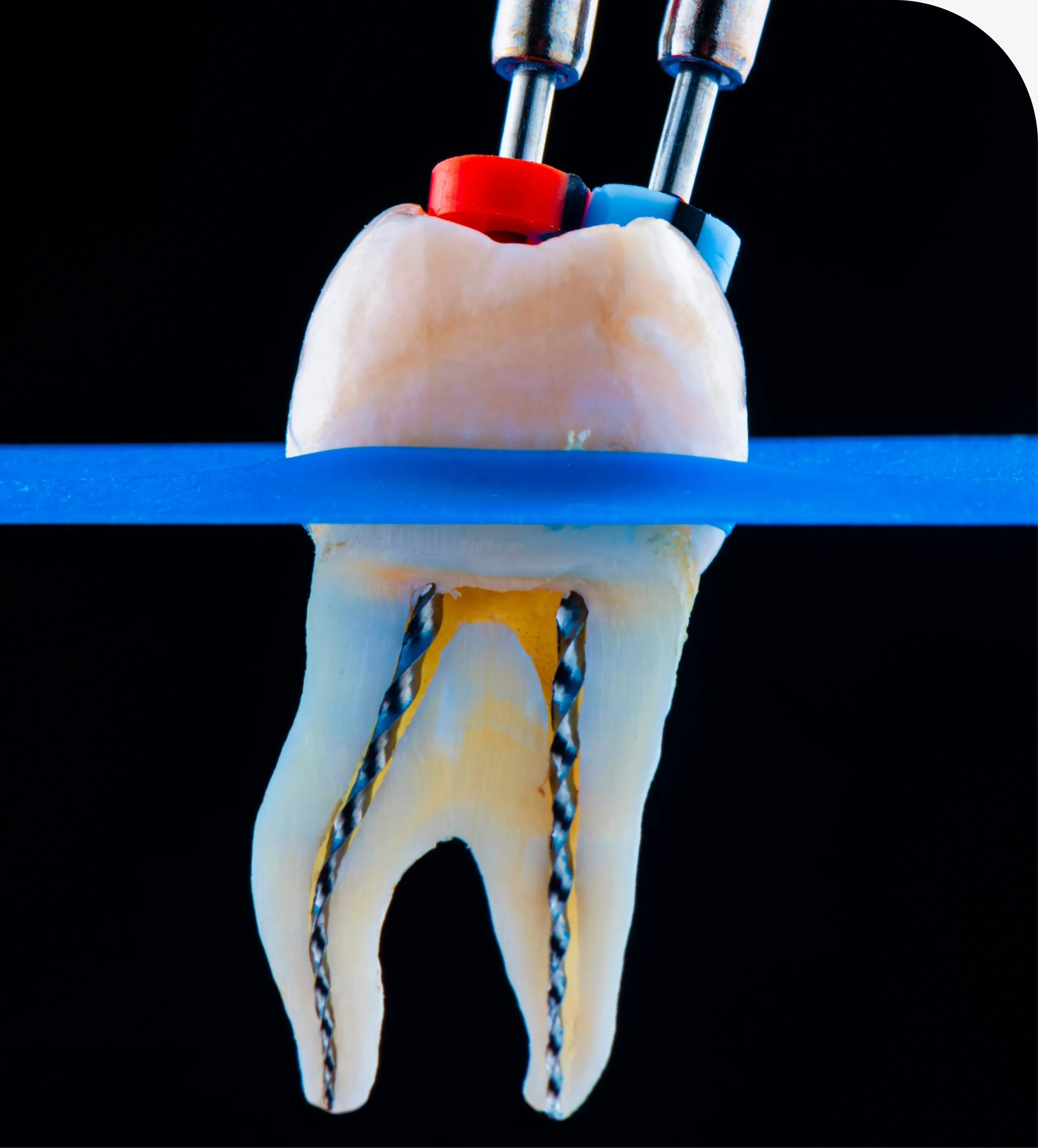 Root Canal Therapy