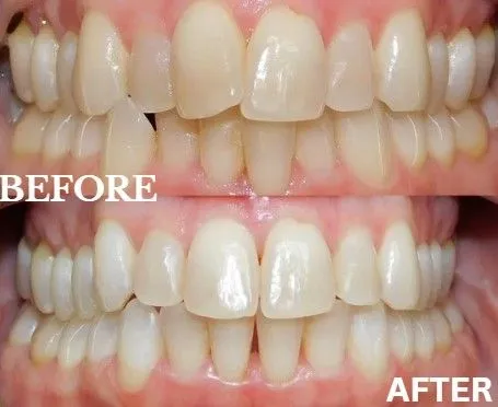 SureSmile before and after