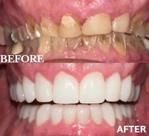 Veneers before and after