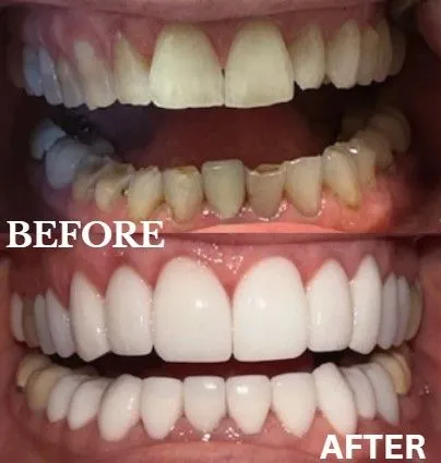 Veneers before and after