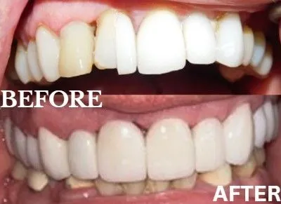 Veneers before and after