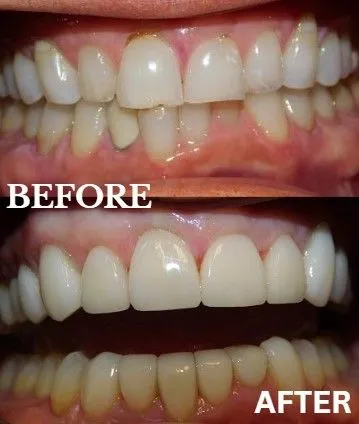 Veneers before and after