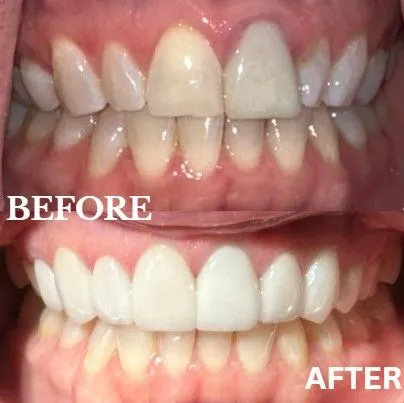 Veneers before and after