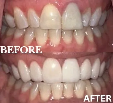 Veneers before and after