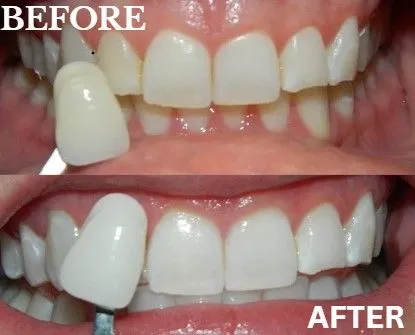 Veneers before and after
