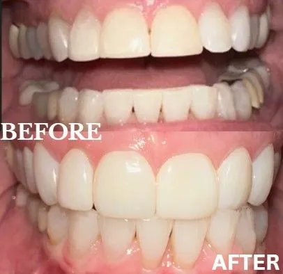 Veneers before and after