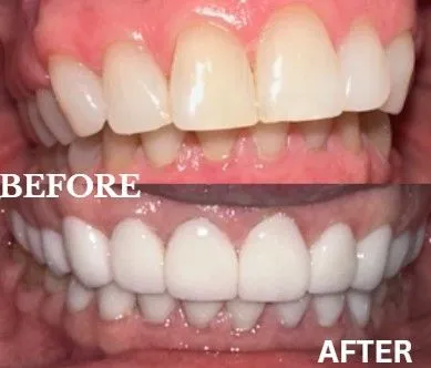 Veneers before and after