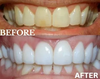 Veneers before and after