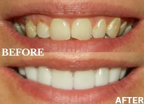Veneers before and after