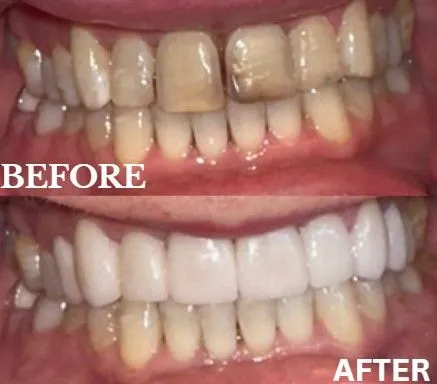 Veneers before and after