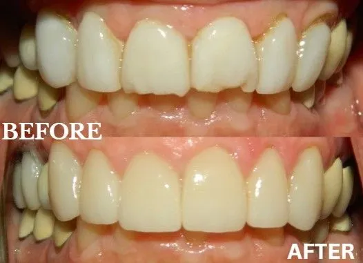 Veneers before and after