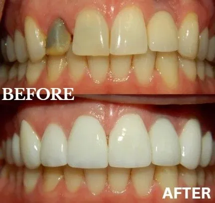 Veneers before and after