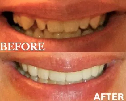 Veneers before and after