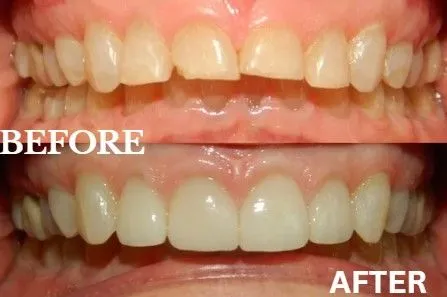 Veneers before and after