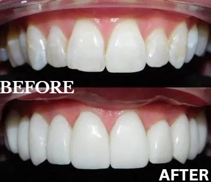 Veneers before and after