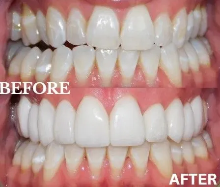 Veneers before and after