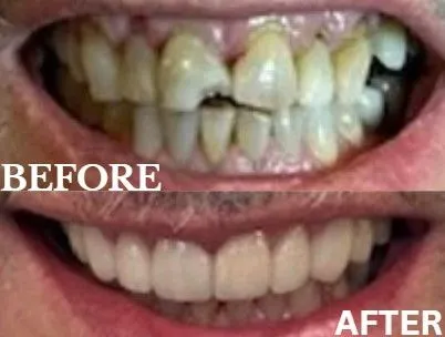 Veneers before and after