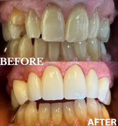 Veneers before and after