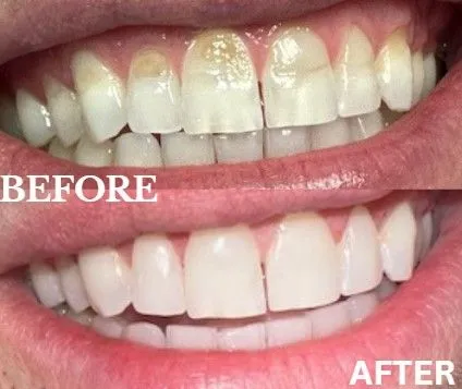Veneers before and after