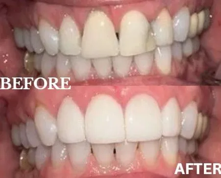 Veneers before and after