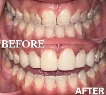 Veneers before and after