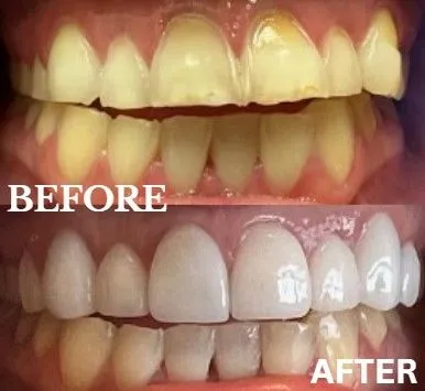 Veneers before and after