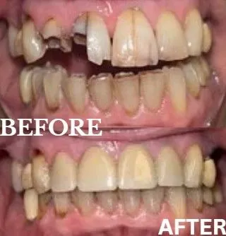 Veneers before and after