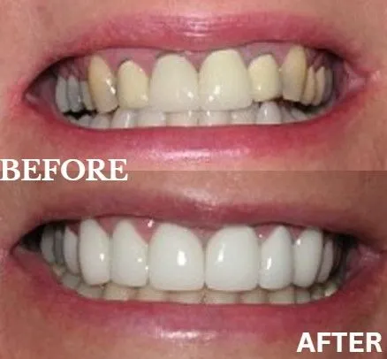 Veneers before and after