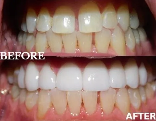 Veneers before and after
