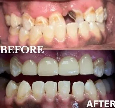 Veneers before and after