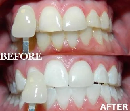Zoom whitening before and after