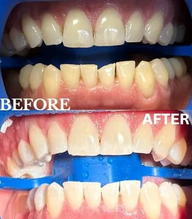 Zoom whitening before and after
