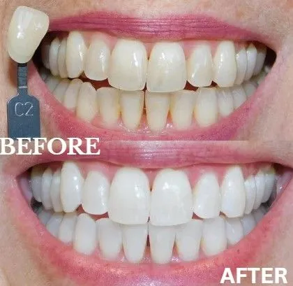 Zoom whitening before and after