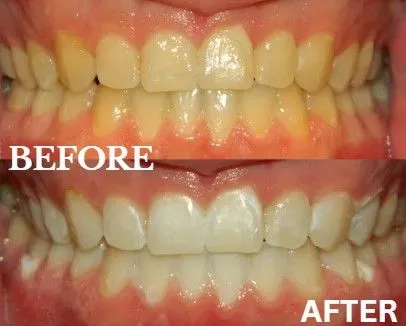 Zoom whitening before and after