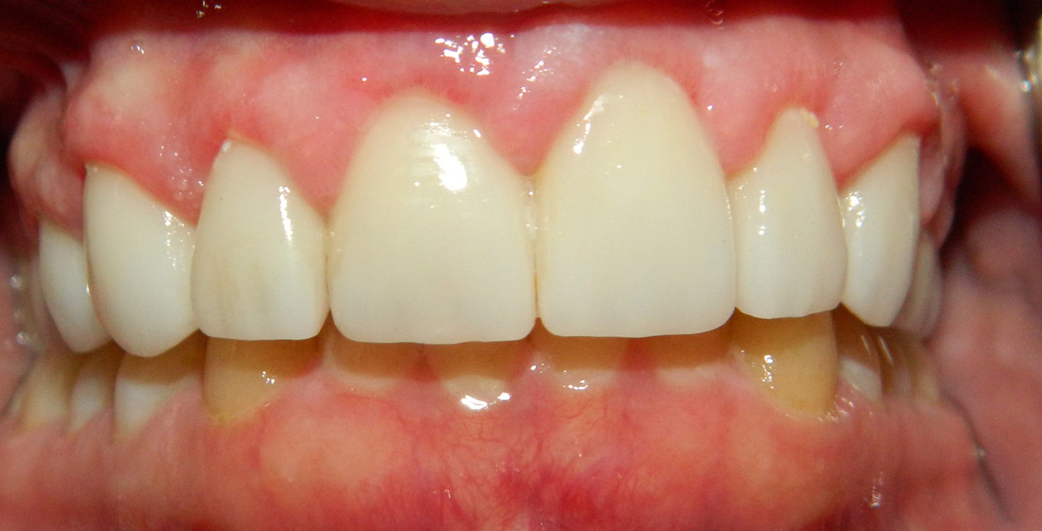 After Image: Gum Contouring - front