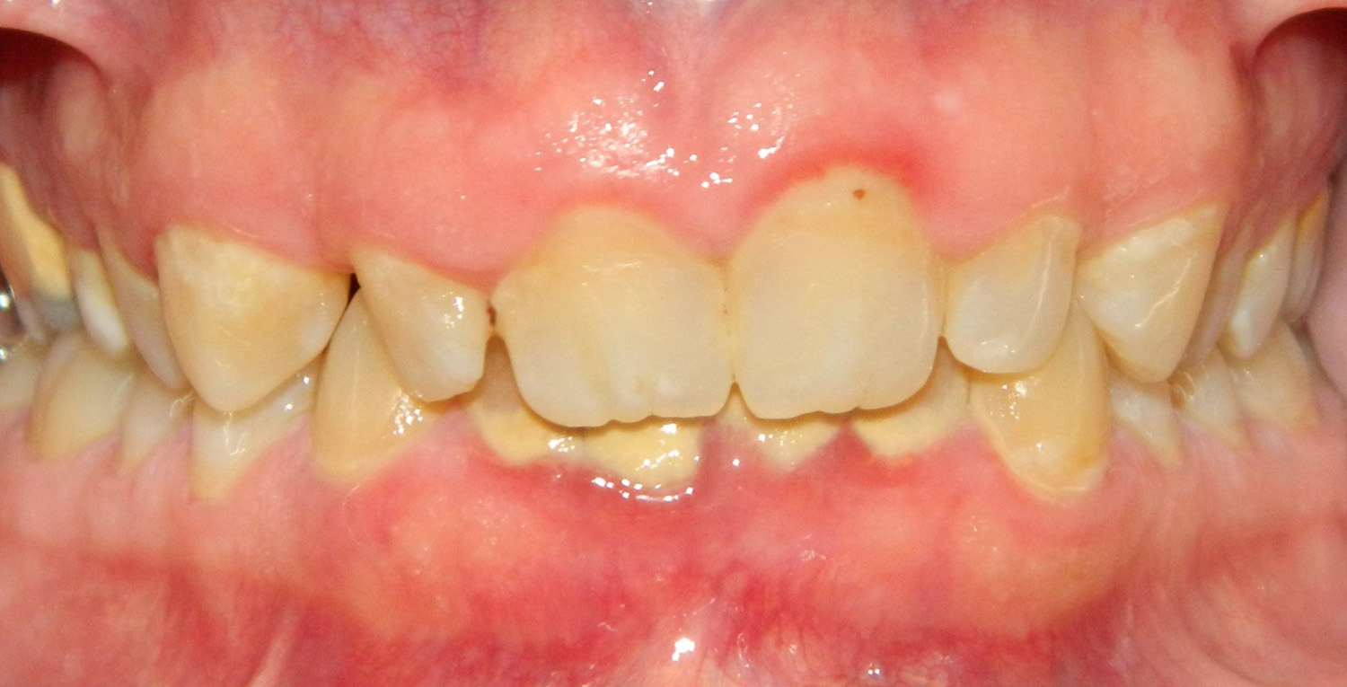 Before Image: Gum Contouring - front