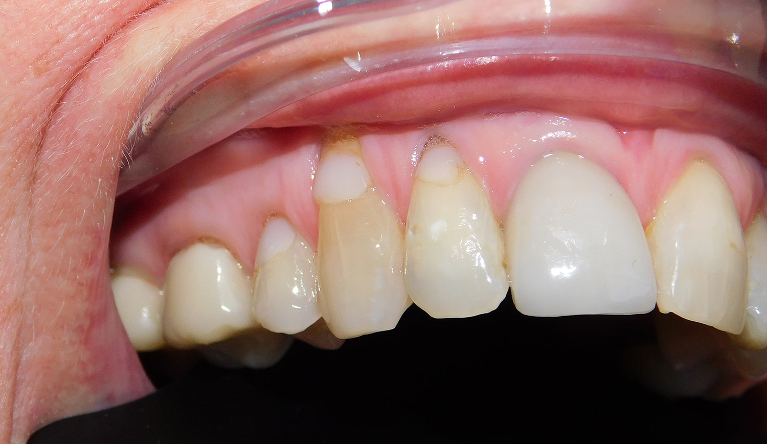 Before Image: Pinhole - right-front-oblique