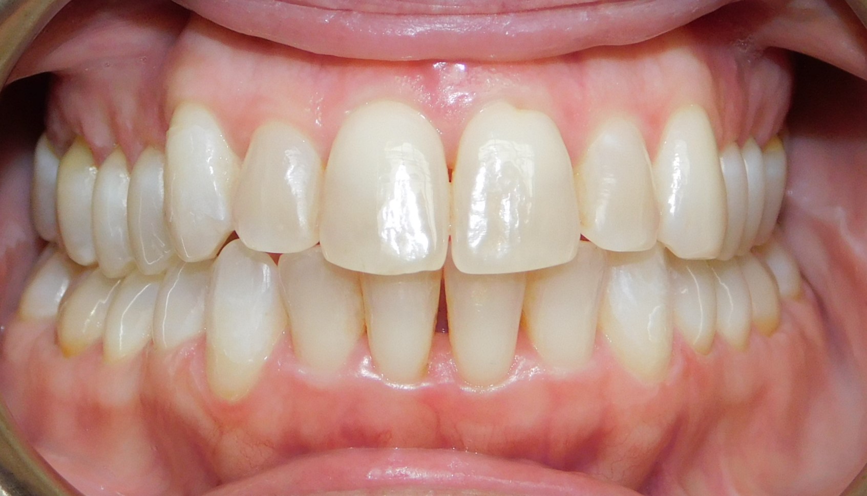 After Image: Clear Aligners - front
