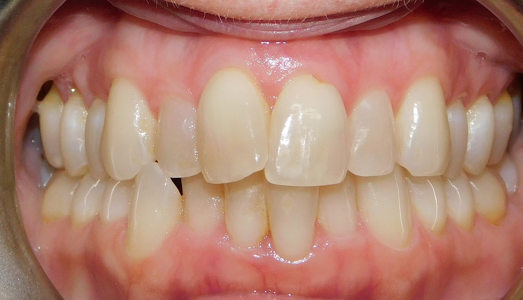 Before Image: Clear Aligners - front