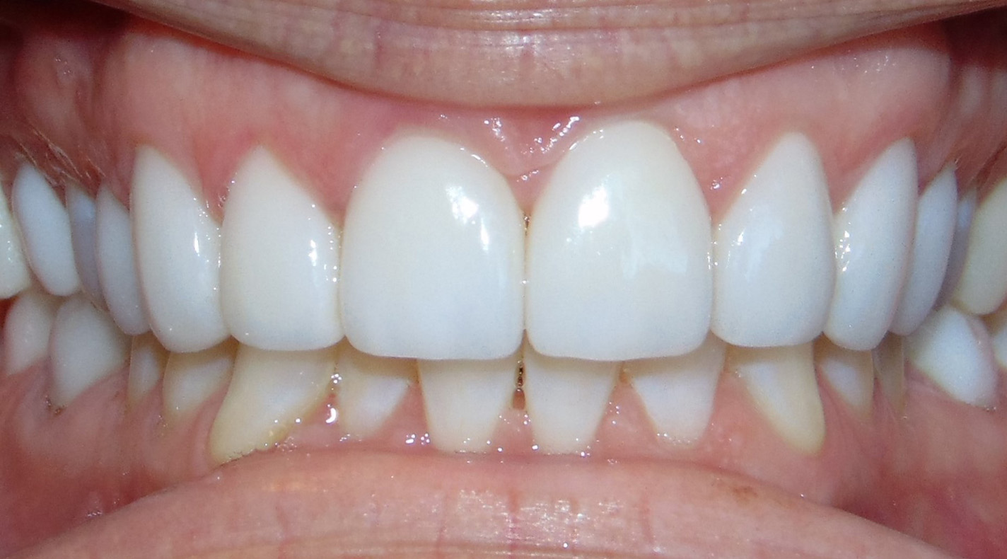 After Image: Veneers - front