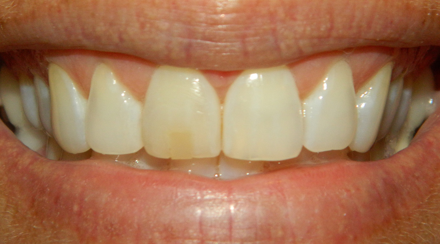 Before Image: Veneers - front
