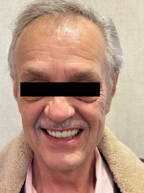 After Image: Veneers - front